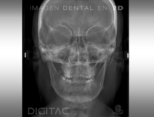 Telerradiografía Anteroposterior & Posteroanterior Digitac Dental