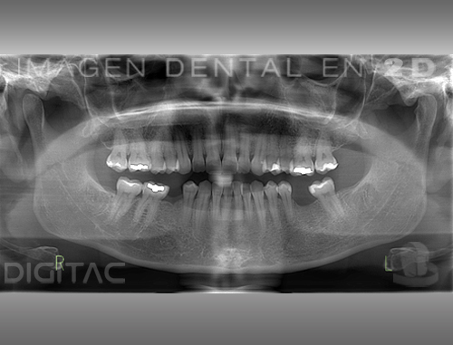 Ortopantomografía Digitac Dental