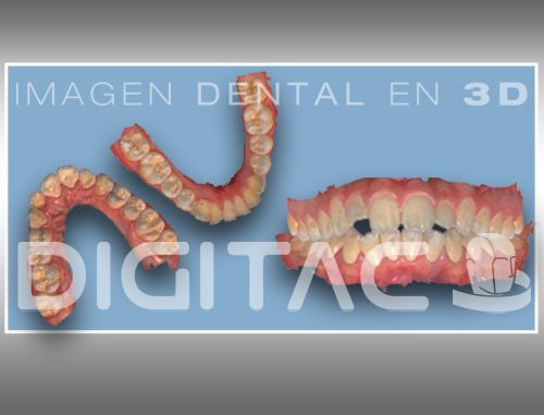 STL - Invisalign - Ortodoncia invisible - Digitac Dental