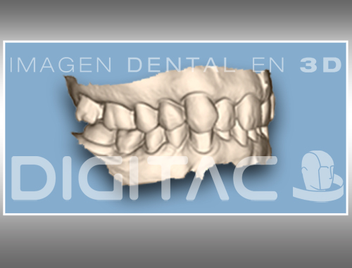 STL Modelo dental Digitac Dental