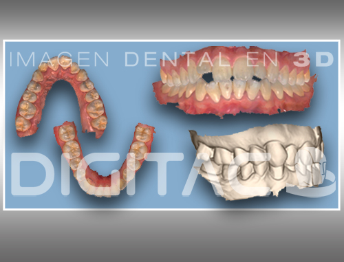 STL Modelo dental - Ortodoncia invisible - Digitac Dental