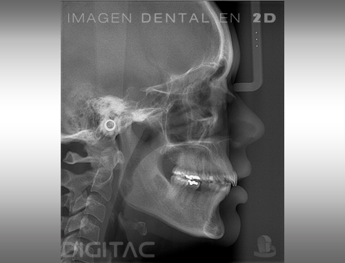 Telerradiografía Digitac Dental